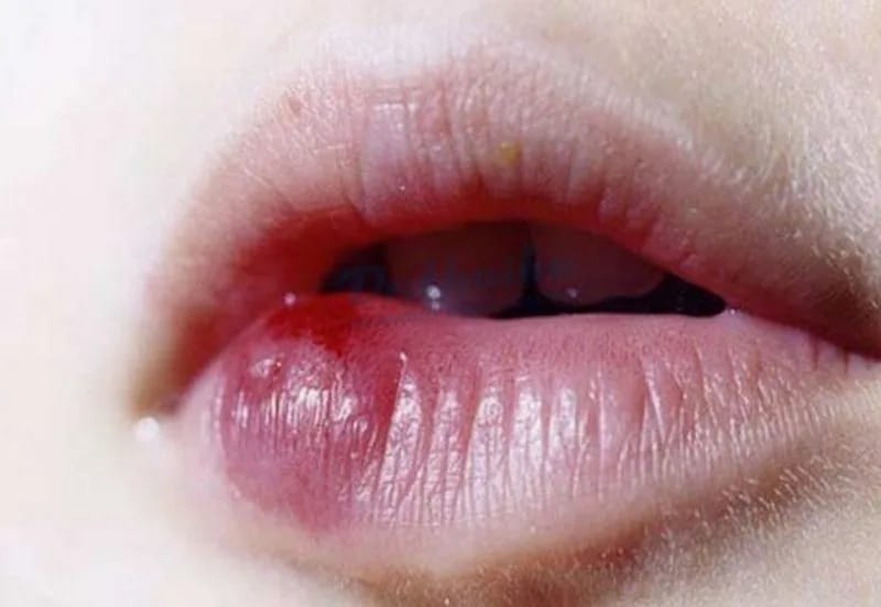 Tác dụng phụ nghiêm trọng hiếm gặp khi tiêm tan Filler 