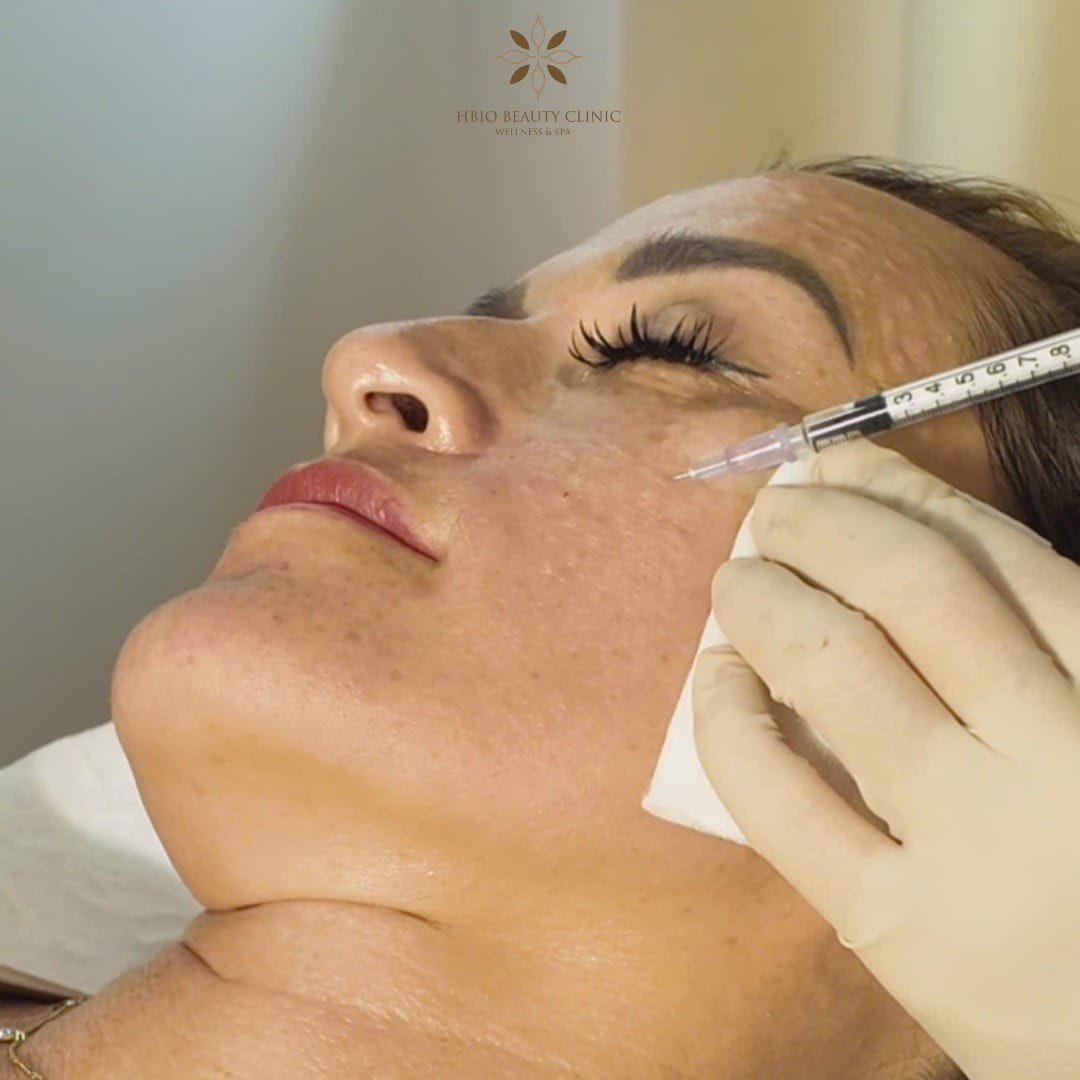 Tiêm filler – Làm đầy sẹo rỗ tức thì