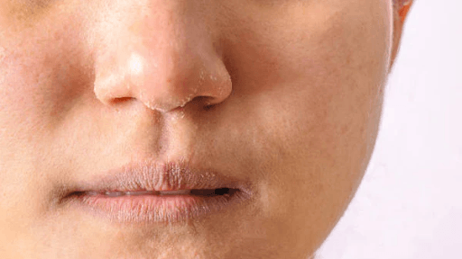 Biểu hiện da thiếu nước dễ nhận biết nhất