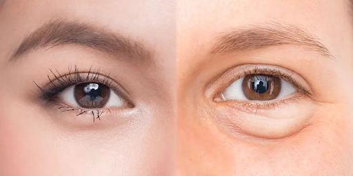 Cắt mỡ bọng mắt – trẻ hóa lâu dài vùng da quanh mắt