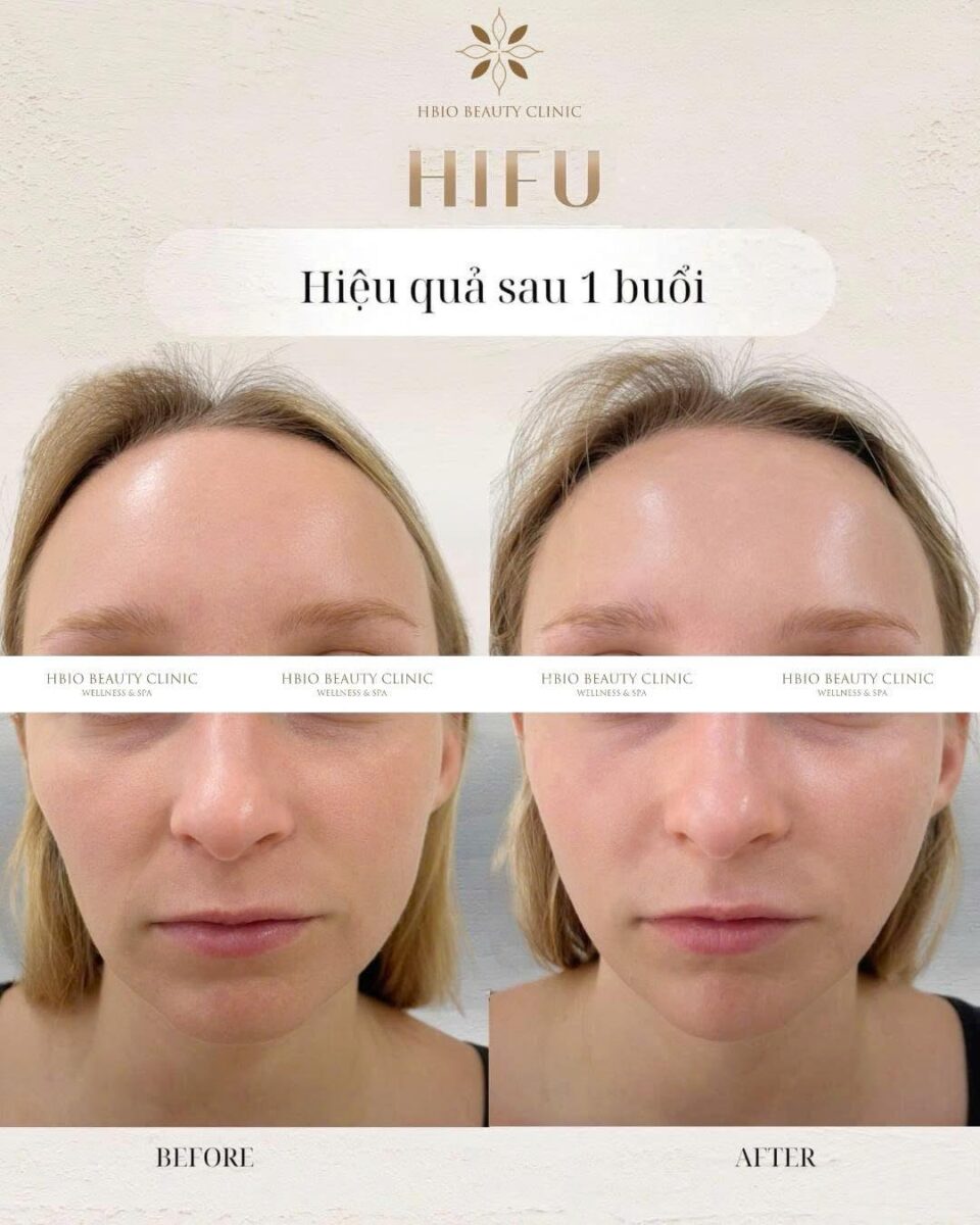 HIFU – nâng cơ sâu, trẻ hóa không xâm lấn