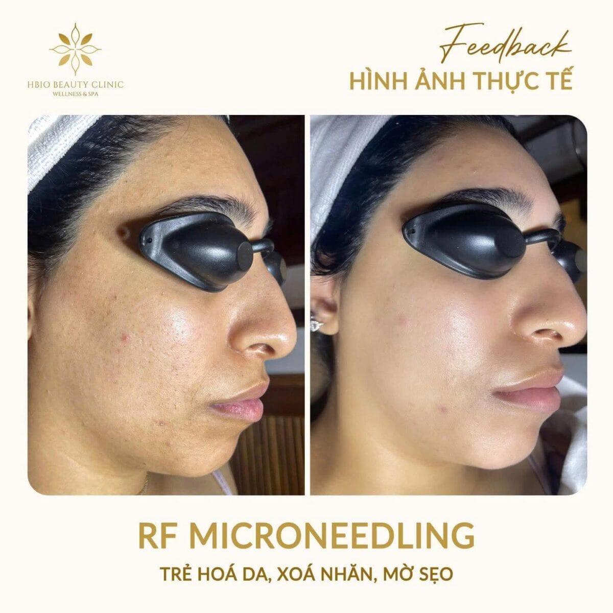 Hình ảnh trước và sau khi thực hiện RF Microneedling tại HBIO