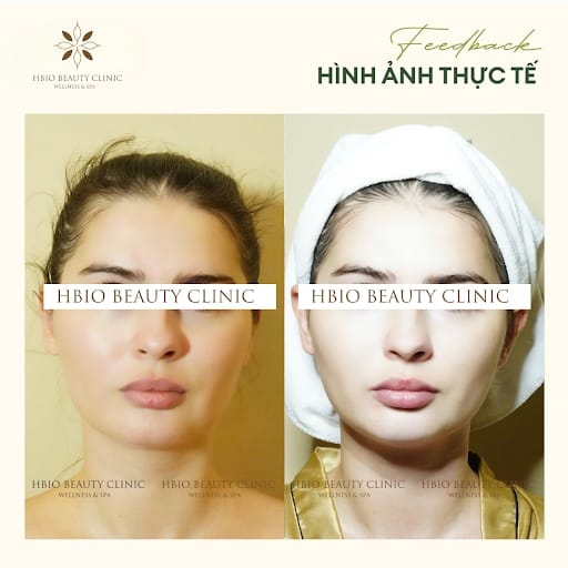 Khách hàng trải nghiệm thực tế công nghệ hifu tại HBIO Clinic