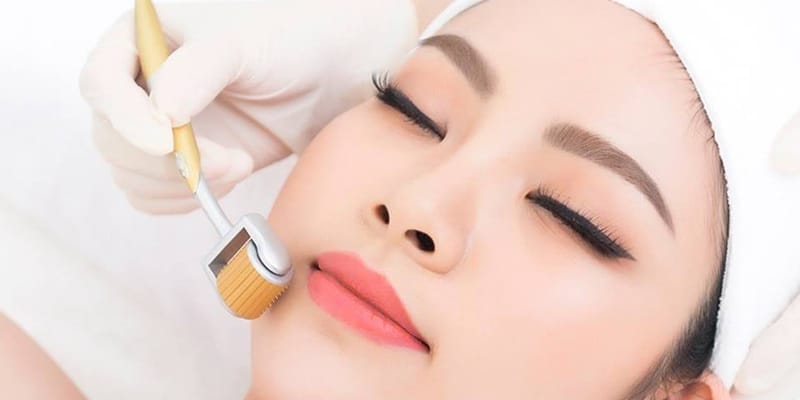 Lăn kim (Microneedling) xóa nếp nhăn khóe miệng