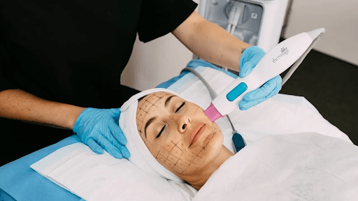 Lợi ích của Ultherapy và Thermage đối với từng vùng da