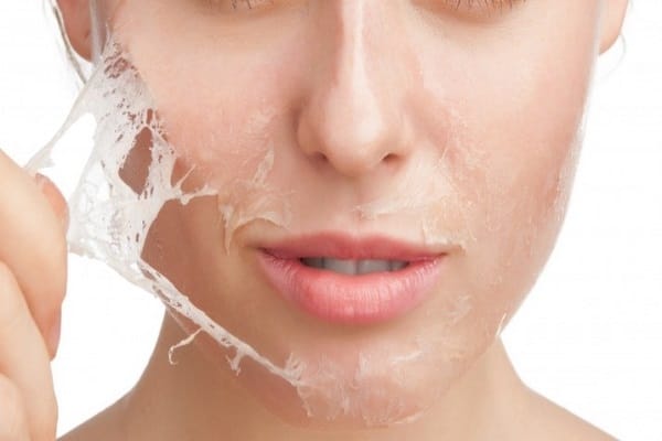 Lột da hóa học (Chemical Peel) xóa nếp nhăn khóe miệng