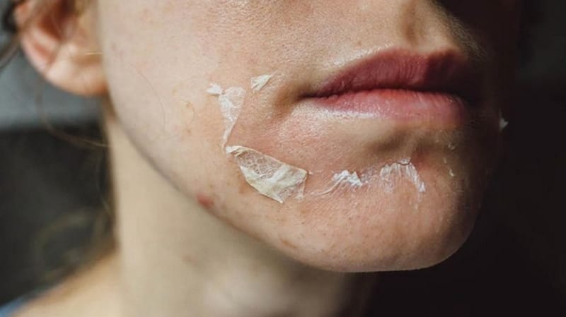 Peel da hóa học (Chemical Peels)