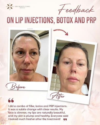 PRP kết hợp tế bào gốc (công nghệ tái tạo kép)