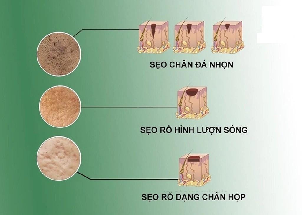 Các loại sẹo rỗ phổ biến nhất