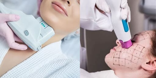So sánh Ultherapy và Thermage