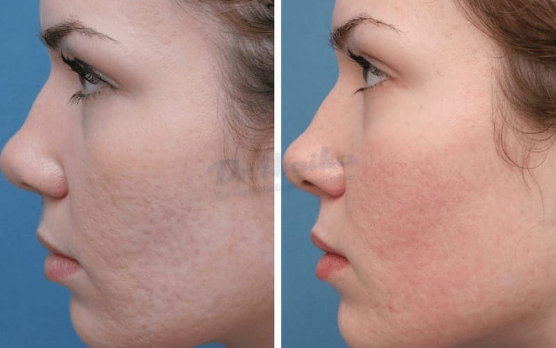 Tiêm Filler – Làm đầy sẹo rỗ tức thì