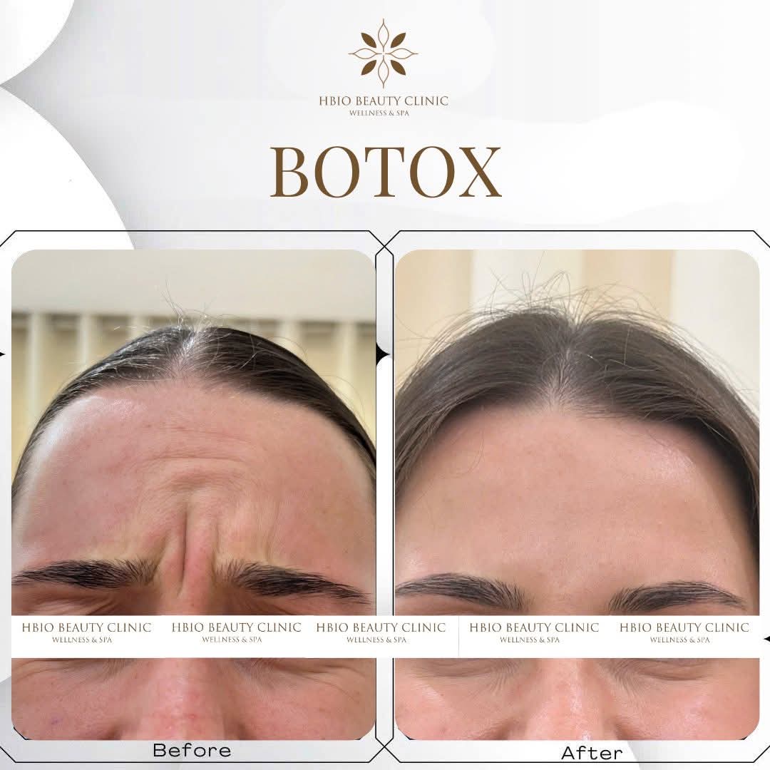 Hình thực tế trước và sau khi thẩm mỹ tại HBIO CLINIC