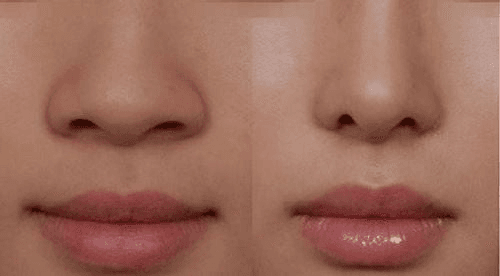 Có nên thu nhỏ đầu mũi không?