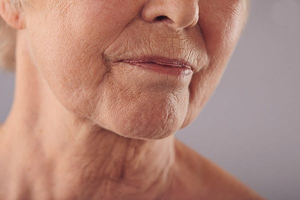 Đường viền hàm chảy xệ là gì?