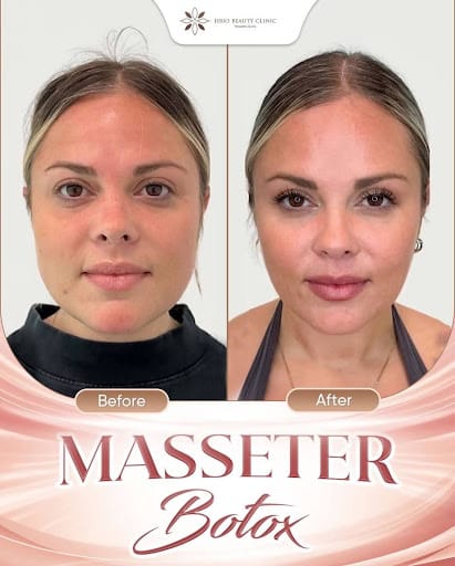 Hình ảnh thực tế trước và sau khi tiêm Botox tại HBIO Clinic