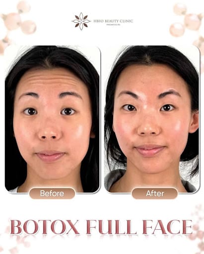 Hình thực tế trước và sau khi tiêm Botox tại HBIO Clinic