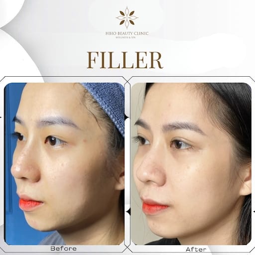 Hình trước và sau khi tiêm filler viền hàm tại HBIO Clinic