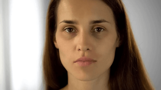 Nguyên nhân khiến hốc mắt sâu