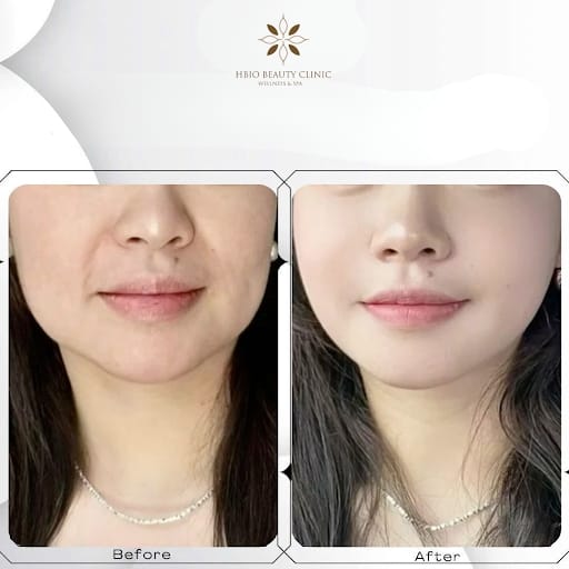 Rãnh cười sâu tốt hay xấu?