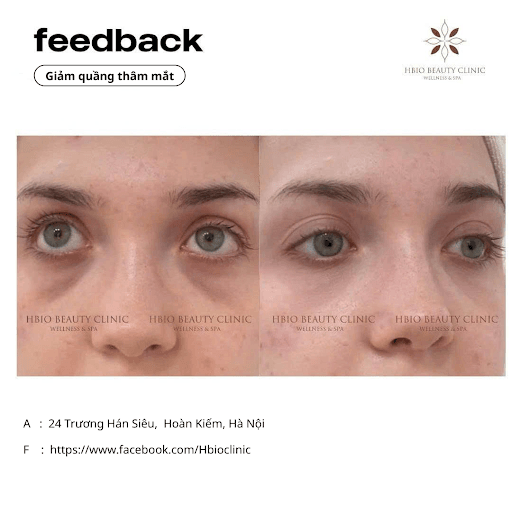 Tiêm Filler là lựa chọn không xâm lấn