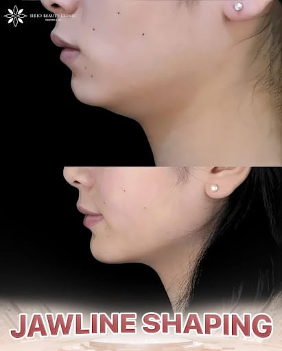 Tiêm Filler viền hàm