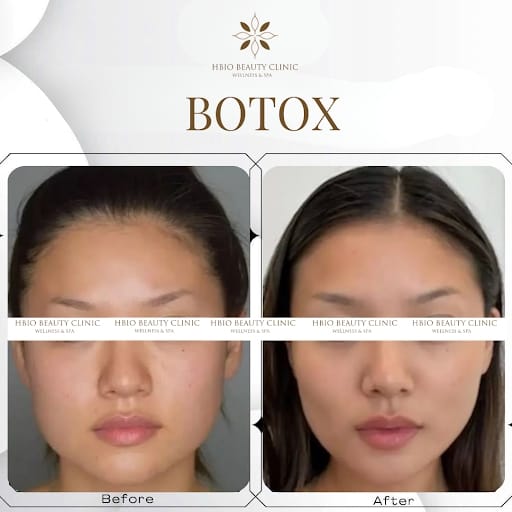 Tiêm gọn hàm bao nhiêu cc là đủ?