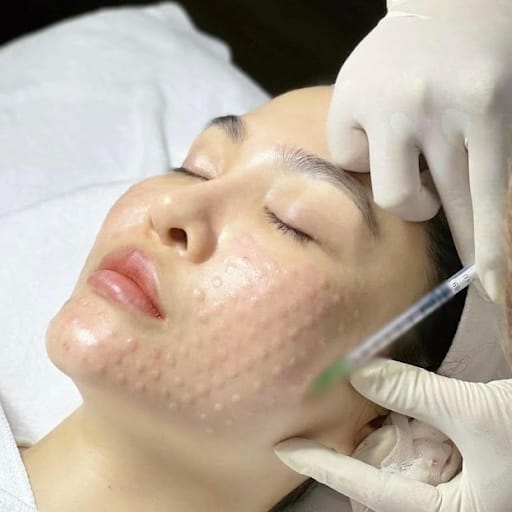 Tiêm meso trị sẹo rỗ