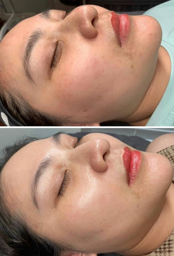 Ảnh trước và sau khi làm đẹp tại HBIO Clinic