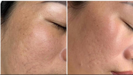 Ảnh trước và sau khi làm đẹp tại HBIO Clinic