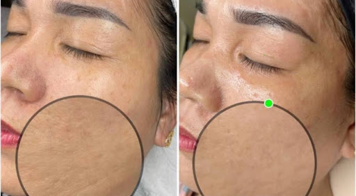 Ảnh trước và sau khi làm đẹp tại HBIO Clinic