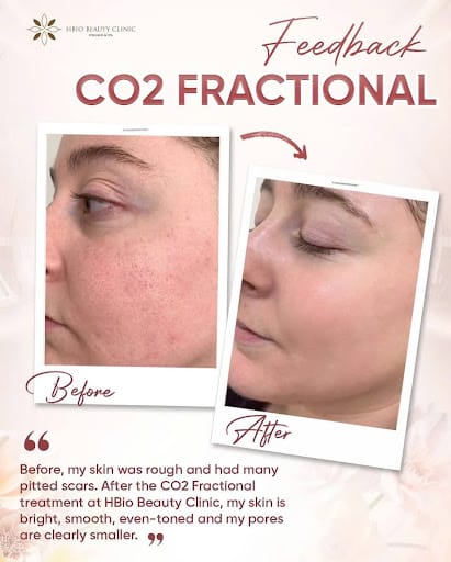 Laser co2 fractional có hiệu quả không?