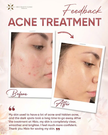 Thời gian vi kim phục hồi chậm hơn phi kim