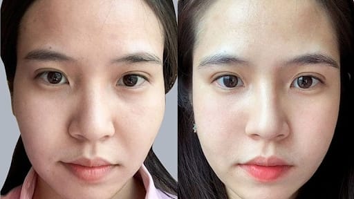 Tiêm filler thái dương có an toàn không?