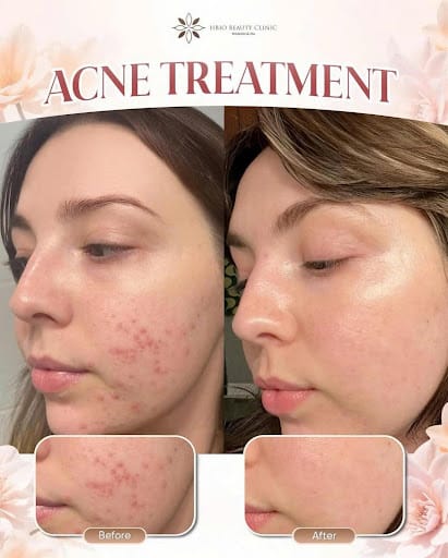 Vì sao nên vi kim tảo biển tại HBIO Clinic?