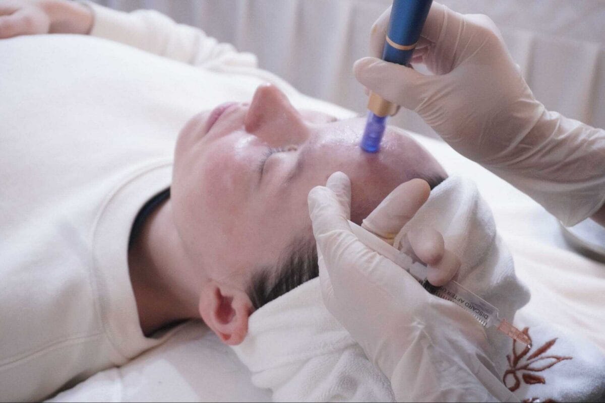 Lăn kim trẻ hóa da kết hợp dưỡng chất