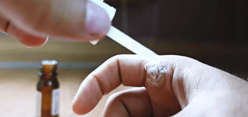 Cách điều trị mụn cóc bằng thuốc 