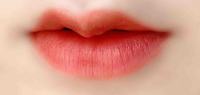 Môi cánh én là gì?
