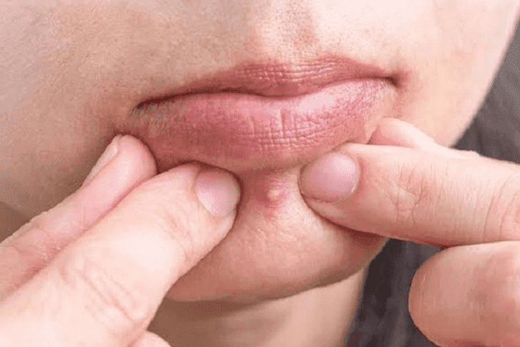 Lấy nhân mụn không đúng cách khiến tình trạng nghiêm trọng hơn