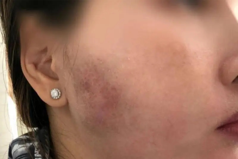 Biểu hiện nguy hiểm đi kèm ngứa sau tiêm