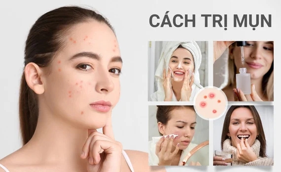 Cách trị mụn li ti an toàn và hiệu quả tại nhà