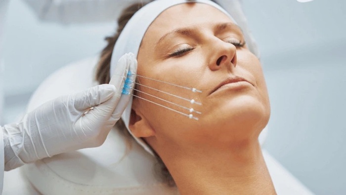 Căng chỉ nâng cơ giúp tinh chỉnh đường nét