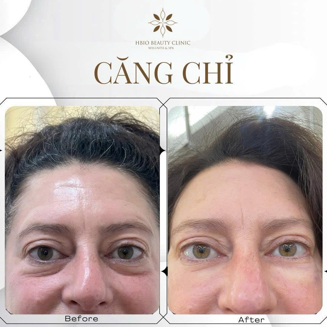 Căng chỉ sinh học nâng cơ