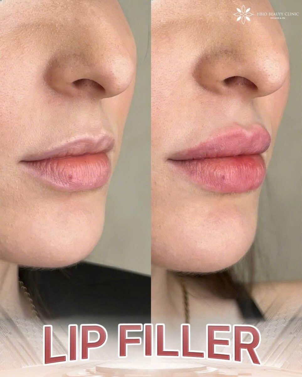 Chi phí tiêm chỉnh môi từ dáng dày thành mỏng