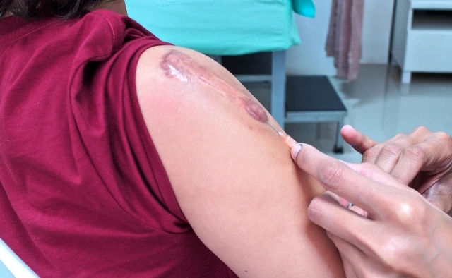 Chi phí tiêm tan sẹo lồi giá bao nhiêu?