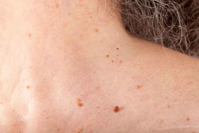 Cơ chế khiến mụn thịt lây lan trên bề mặt da