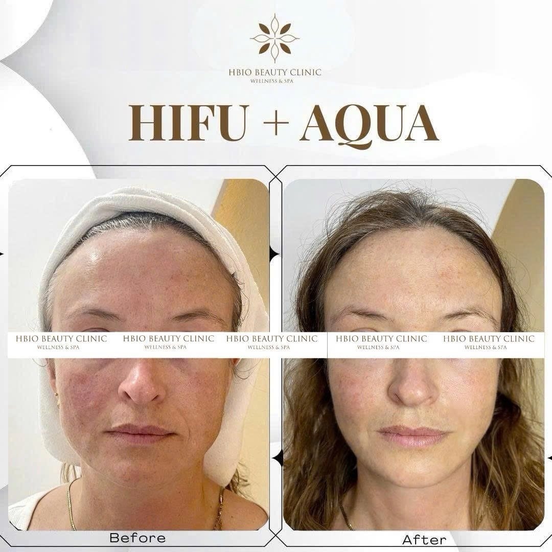 Công nghệ nâng cơ HIFU