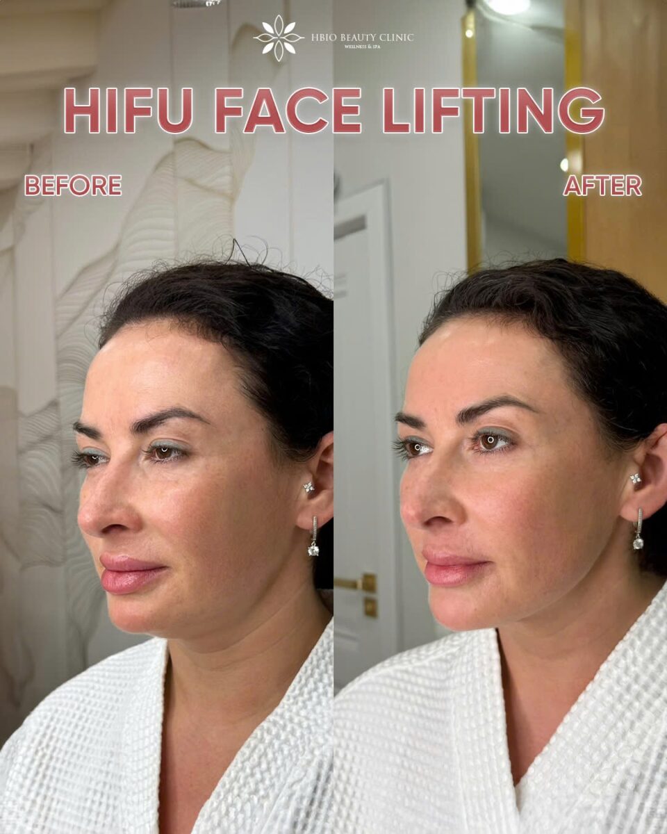 Công nghệ nâng cơ HIFU