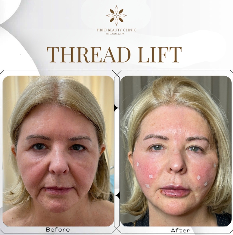 Công nghệ nâng cơ mặt