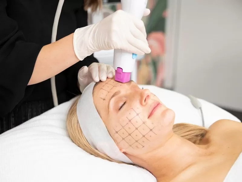 Công nghệ Thermage là gì?