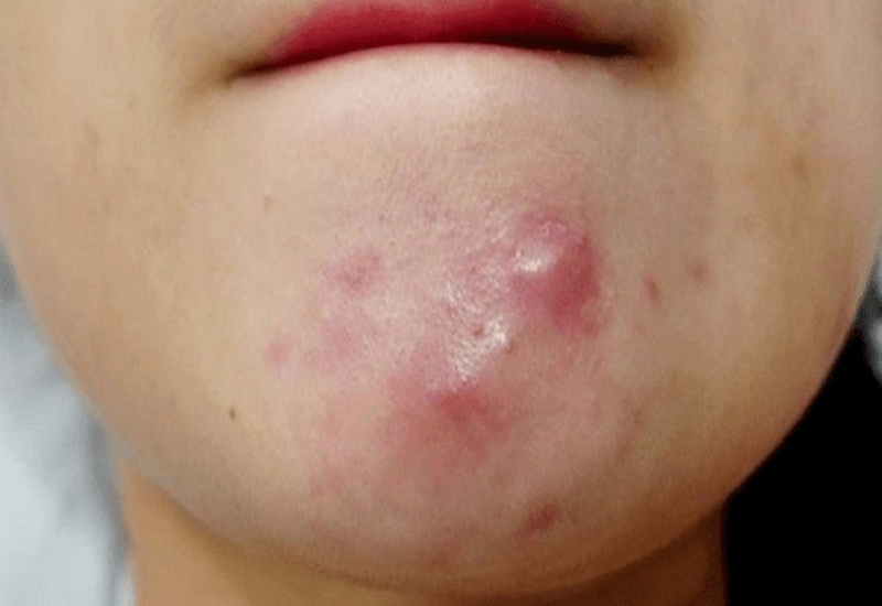 Dấu hiệu dễ nhận biết đó là mụn chai